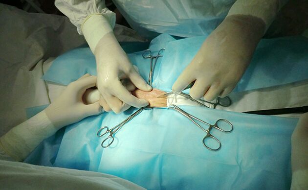 La chirurgia sull'organo riproduttivo aiuterà ad aumentarne le dimensioni
